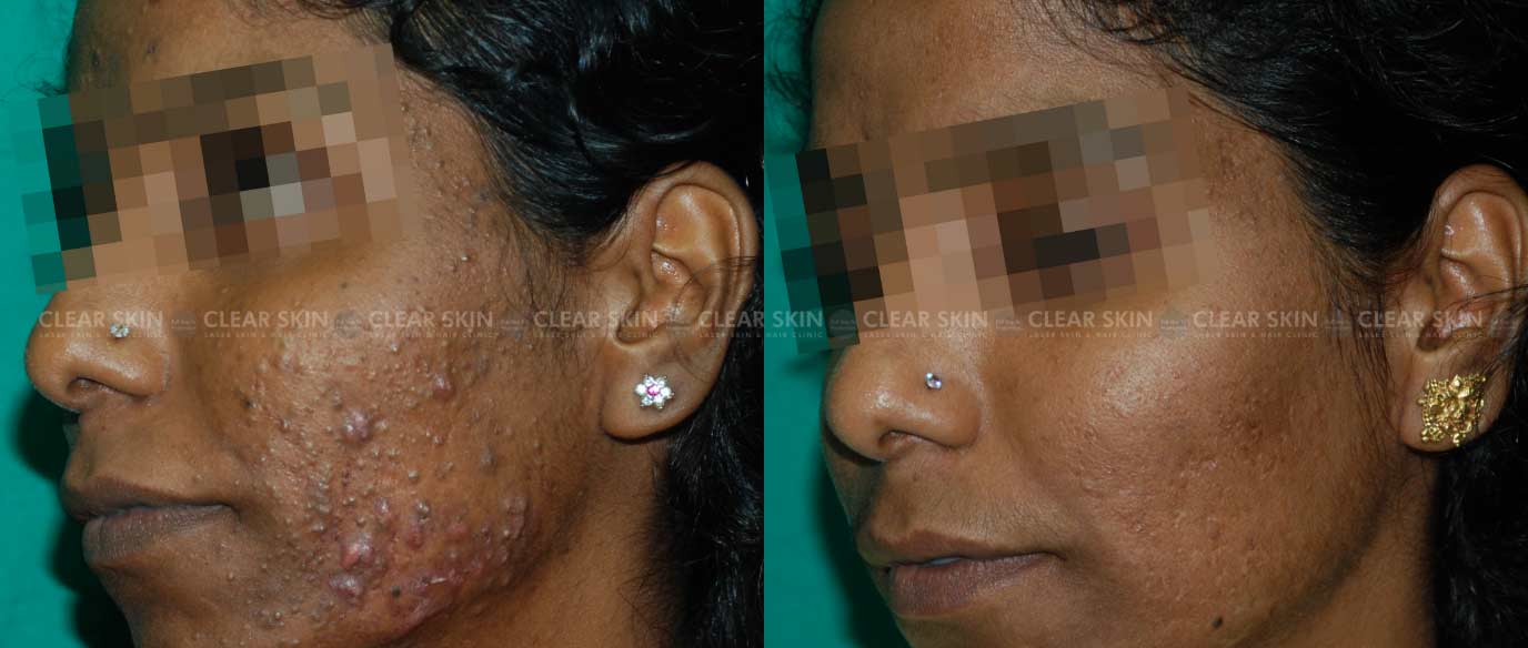Clear Skin Acne Laser  Dr MediSpa Award Winning Clinics