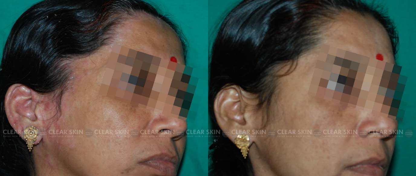 Face Psoriasis Before After