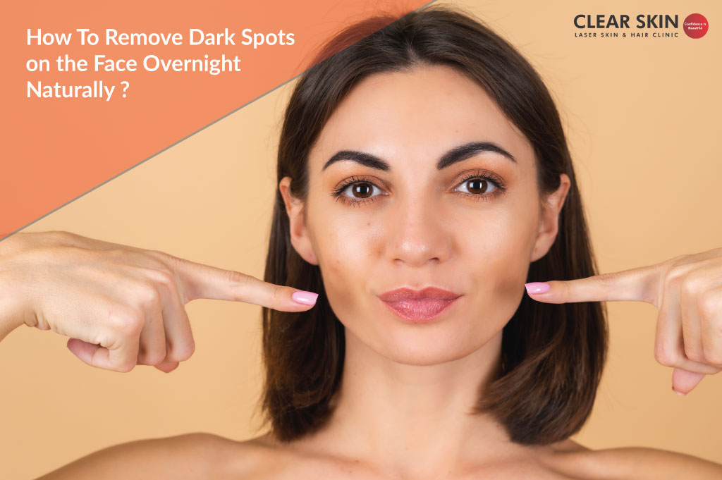 How to Remove Dark Spots on the Face Overnight Naturally?