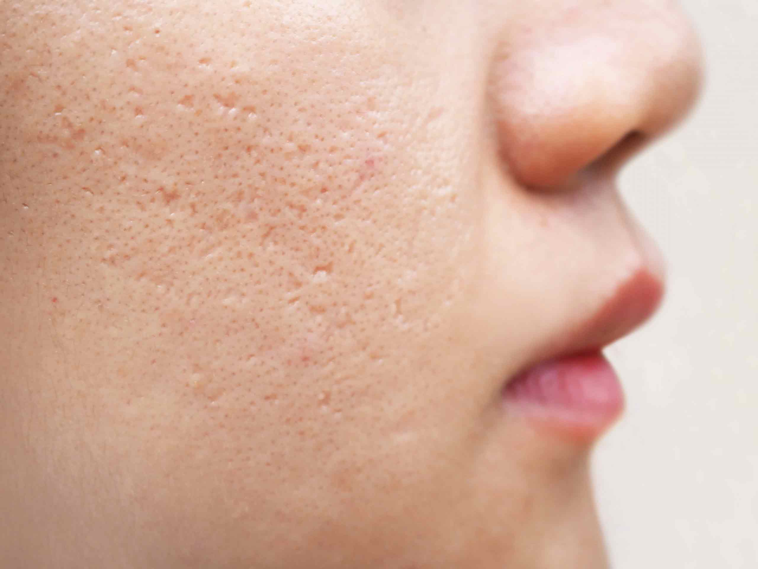 How to remove injury mark on nose | ClearSkin, Pune