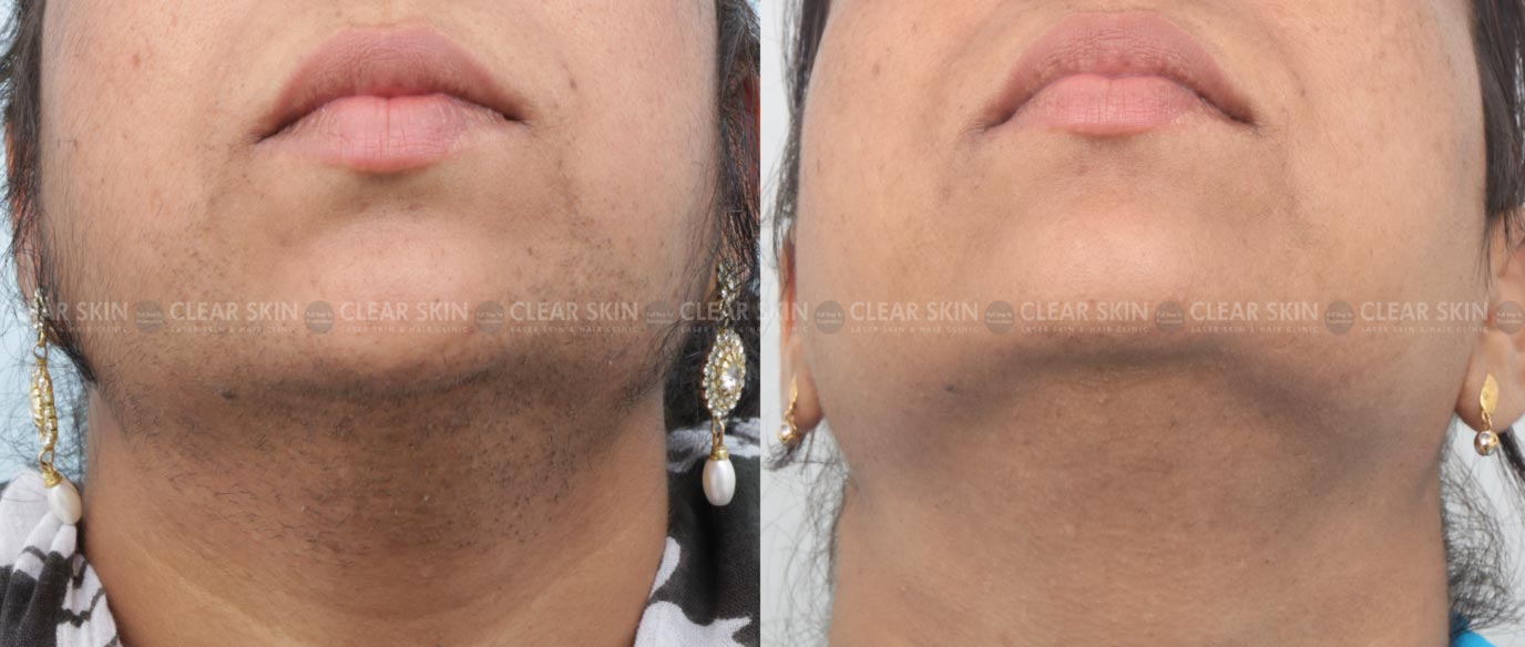 Laser Hair Removal Chin Before And After