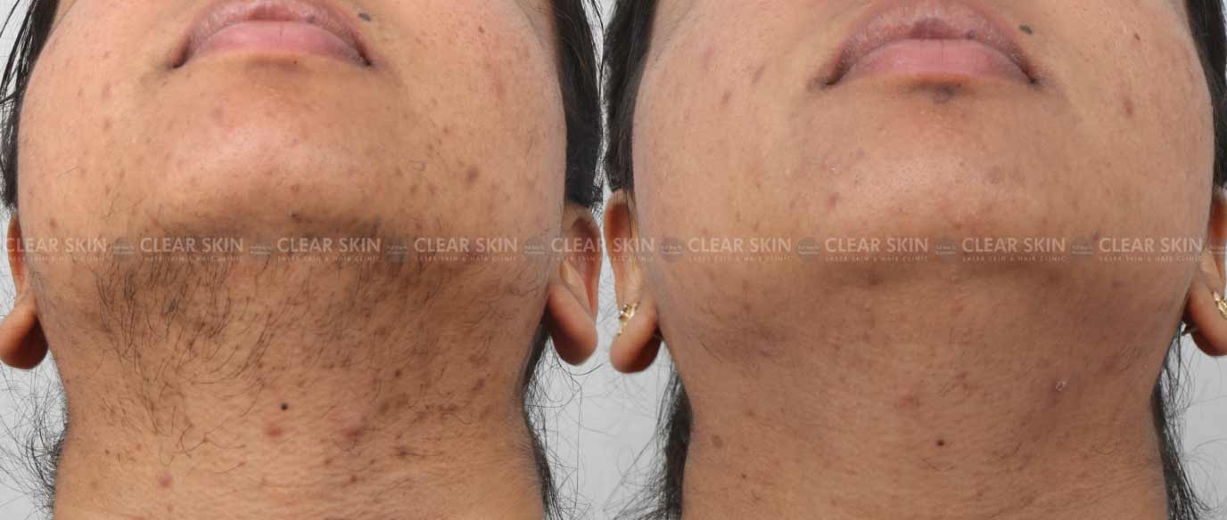Laser Hair Removal Face Before And After
