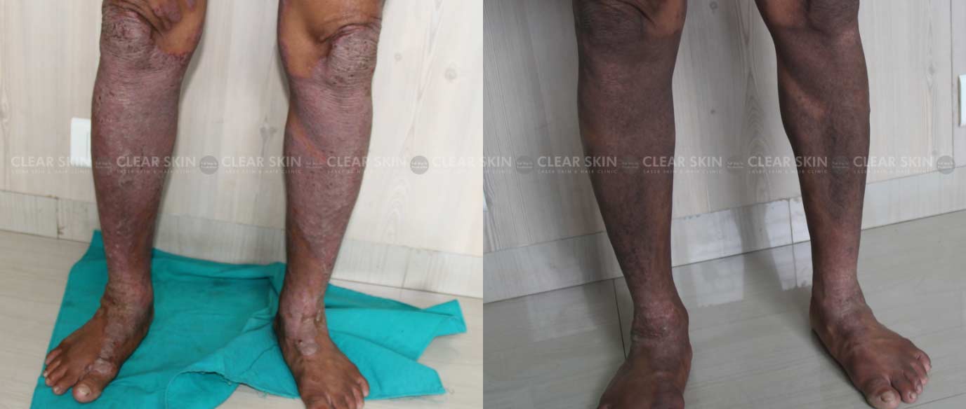 Psoriasis On Leg Before And After