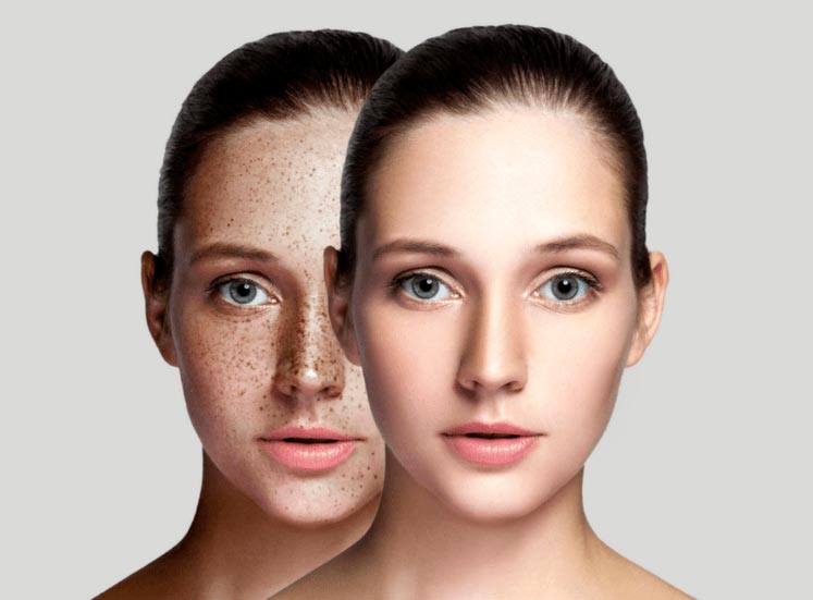 Skin Pigmentation: Causes, Symptoms & Solutions | ClearSkin