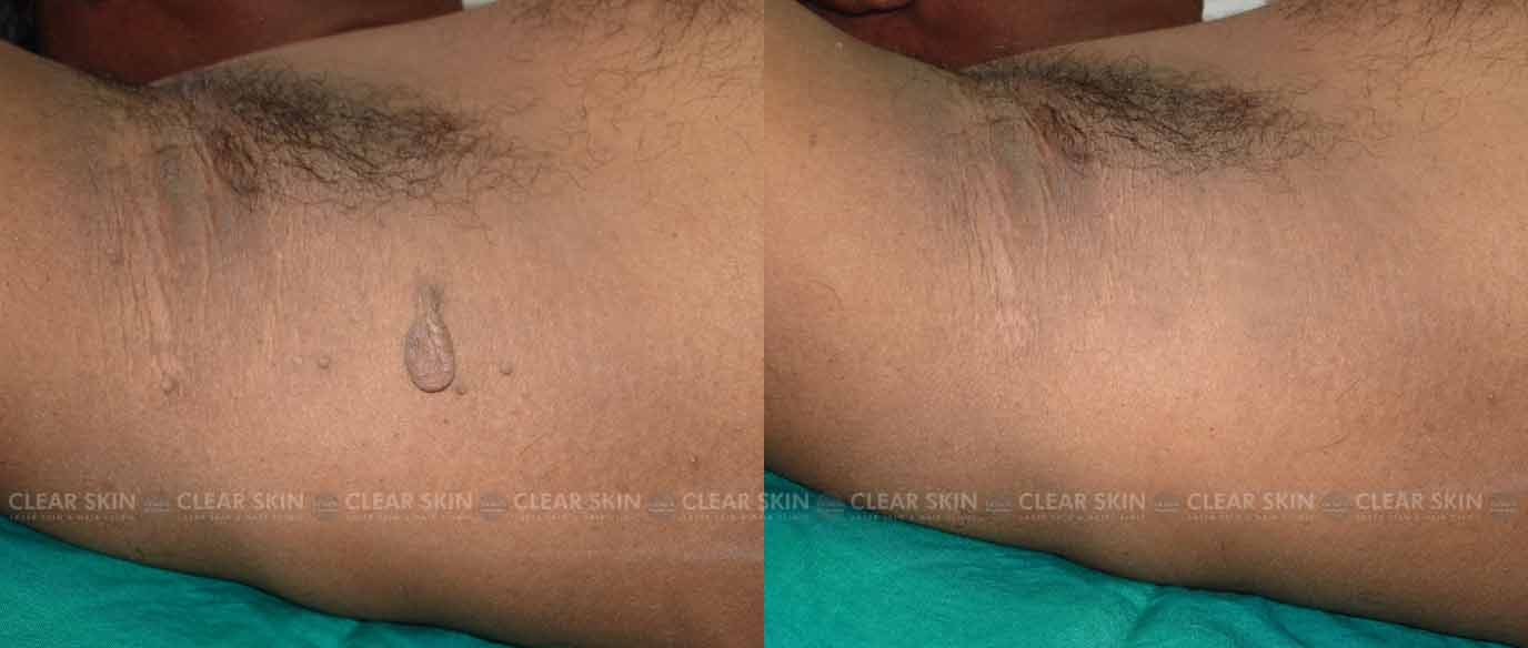 Skin Tag Removal Before And After Results