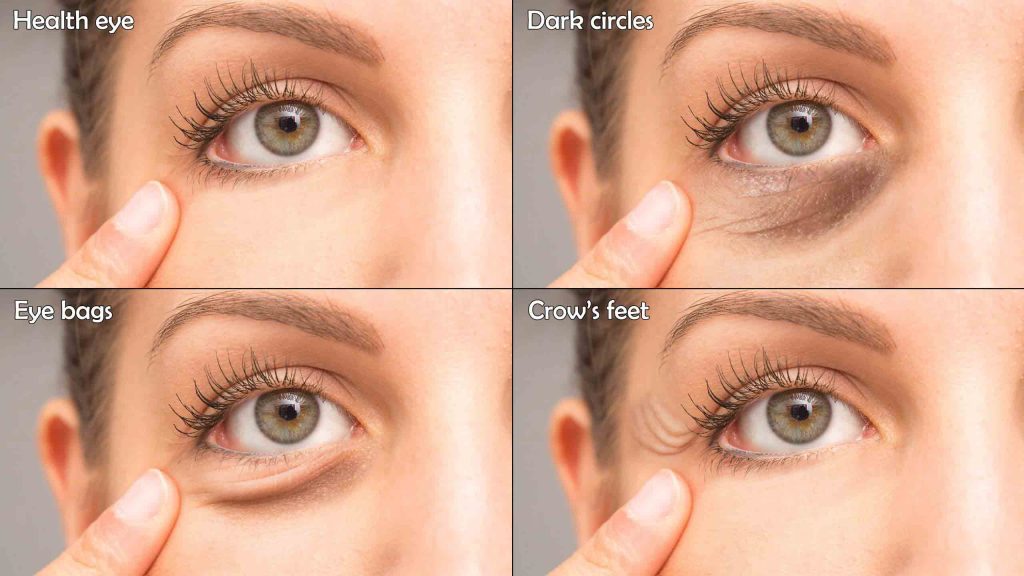 Dark Circles Under Eyes: Causes, Treatment, and Remedies