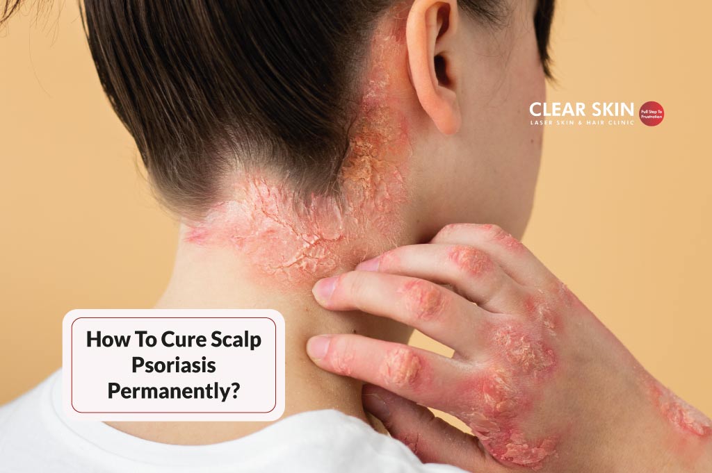 How to Cure Scalp Psoriasis Permanently?