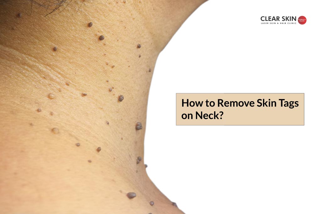 https://www.clearskin.in/wp-content/uploads/2022/07/How-to-Remove-Skin-Tags-on-Neck.jpg