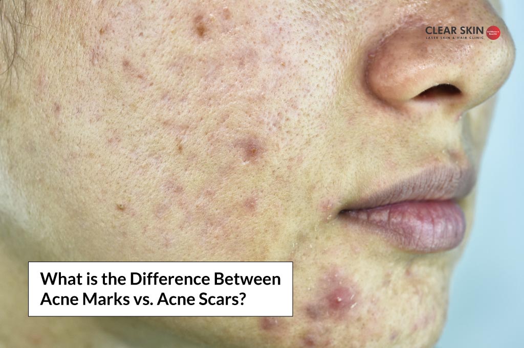 Ordsprog Efternavn efterfølger What is the Difference Between Acne Marks vs. Acne Scars?