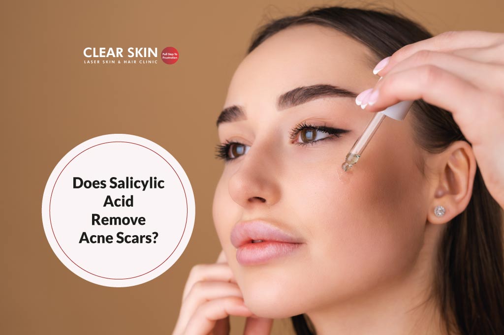 Does Salicylic Acid Remove Acne Scars?