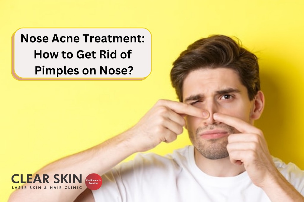 https://www.clearskin.in/wp-content/uploads/2022/08/Nose-Acne-Treatment-How-to-Get-Rid-of-Pimples-on-Nose.jpeg