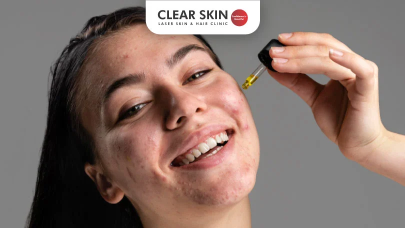 Best Way to Use Salicylic Acid for Acne: Clear Skin Guide