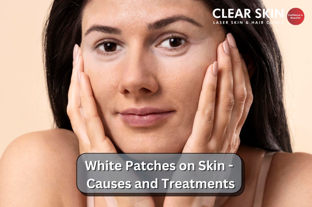 White Patches on Skin - Causes and Treatments