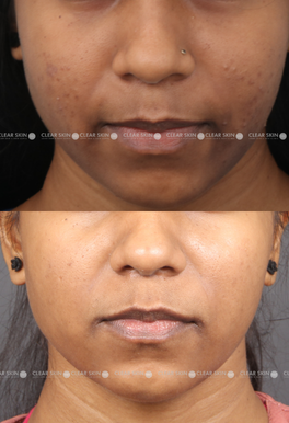 Face pigmentation removal discount