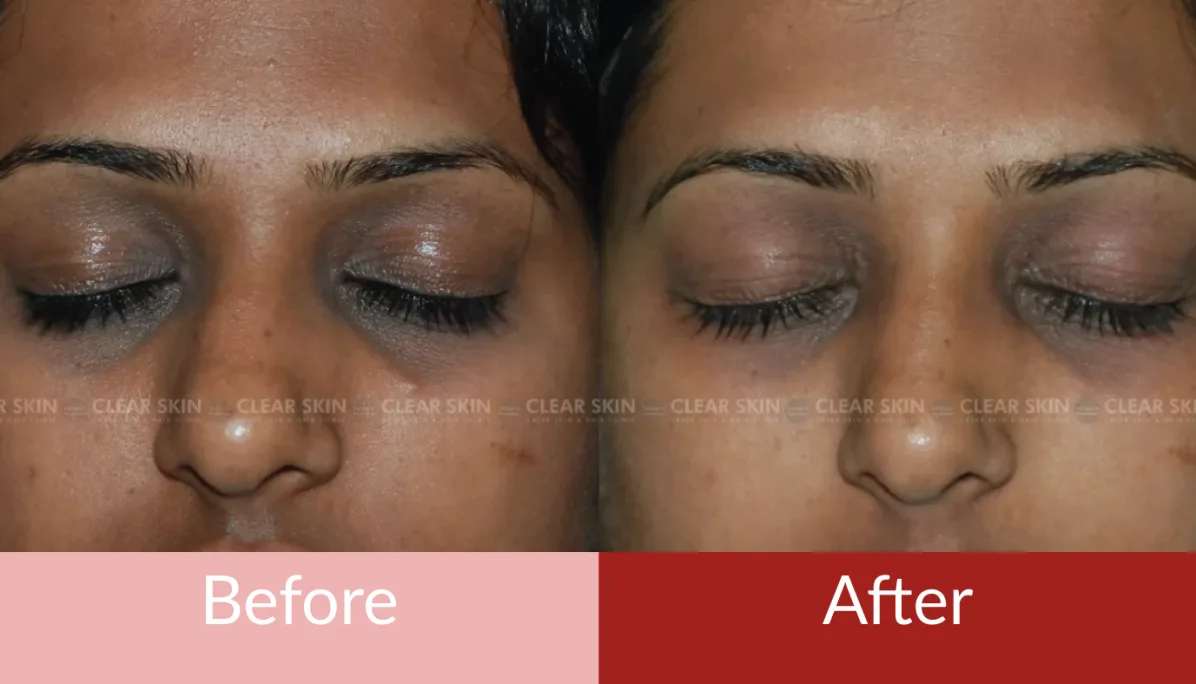 CO2 laser eyelid tightening - experience and recovery