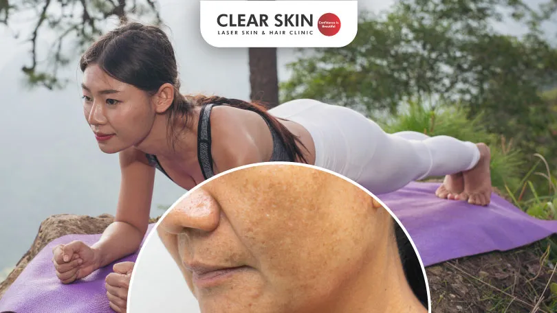 Does Yoga Help to Combat Melasma Clear Skin Pune