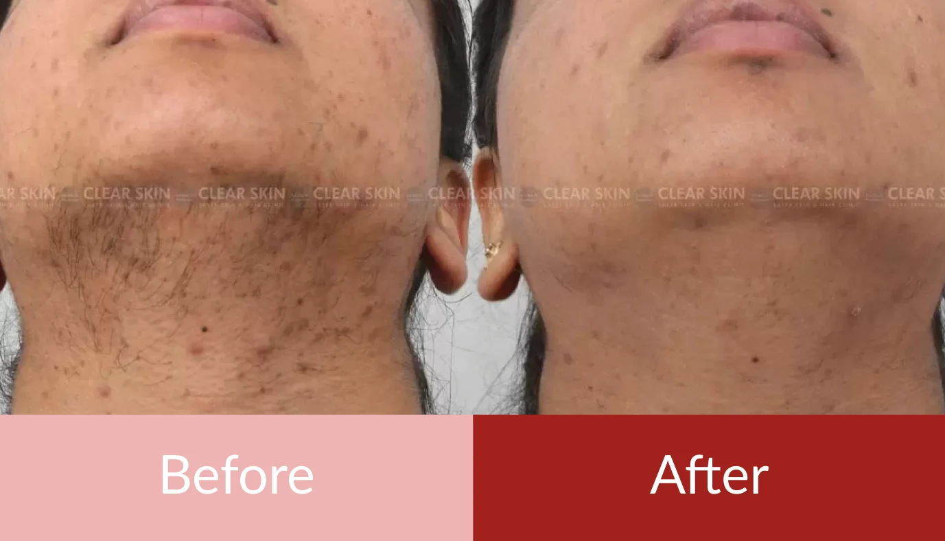 Laser Hair Removal  Success Stories  Square Root Clinic  Gurgaon   YouTube