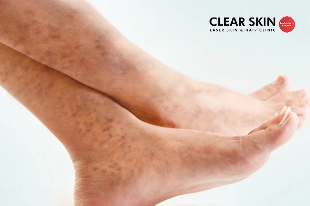 Dark Spots on Legs: Causes and How Can You Remove Them?