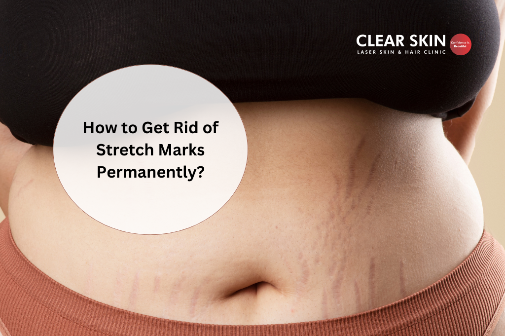 3) How to Get Rid of Stretch Marks Permanently?
