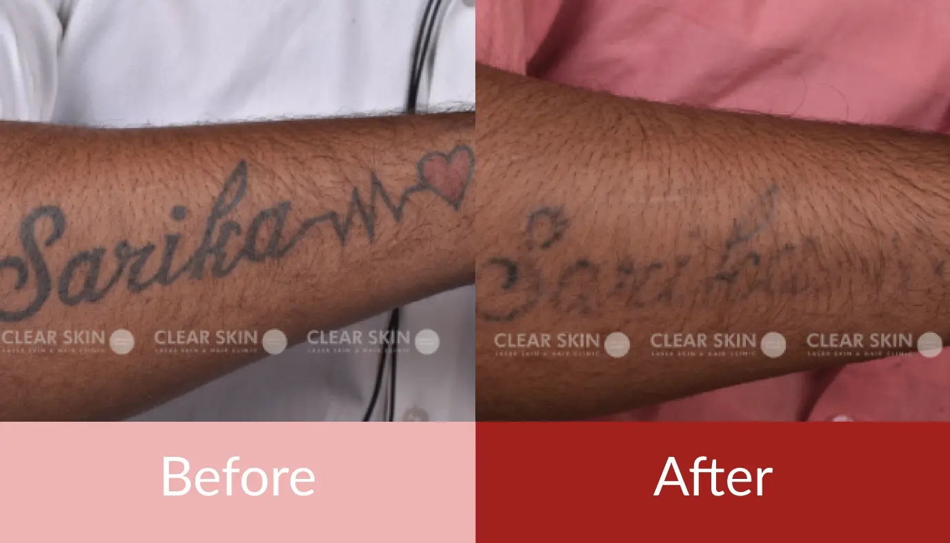 Laser Tattoo Removal Permanent Tattoo Removal Treatment in Mumbai Before  After Results Cost India  YouTube