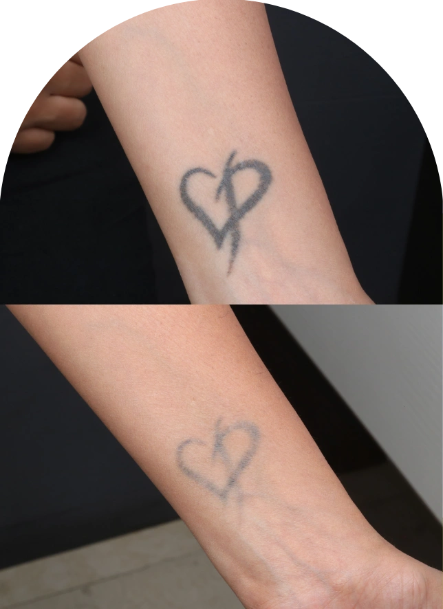 Laser Tattoo Removal Medical Spa  San Diego CA  CLDerm