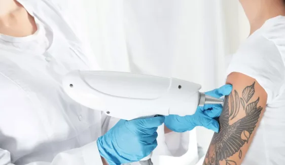 Tattoo Removal Treatment in Pune