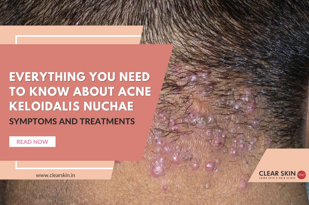 Scalp Acne and Pimples Causes and How to Get Rid of It  Skincarecom