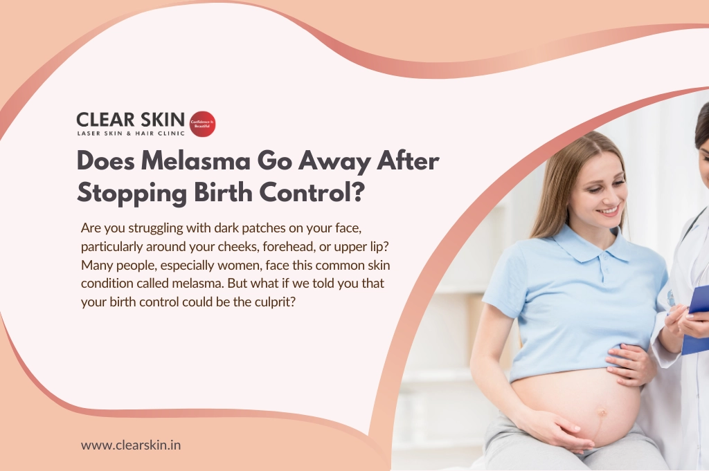 Does Melasma Go Away After Stopping Birth Control?