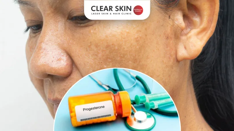 Does Progesterone Cause Melasma does-progesterone-cause-melasma