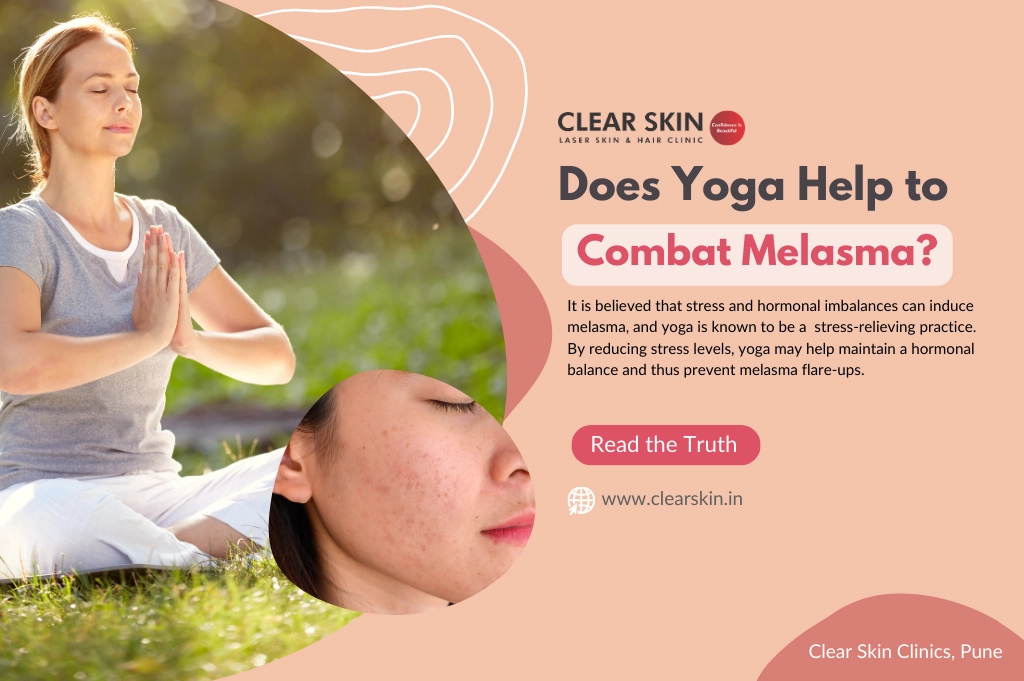 Exploring the Potential Benefits: Can Yoga Help Combat Melasma?
