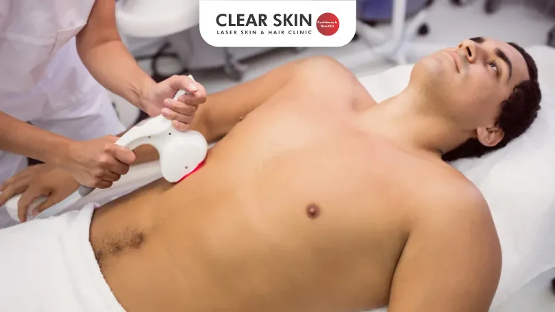 Laser Hair Removal