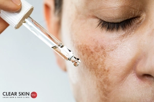 How Does Isotretinoin Work For Melasma Treatment?