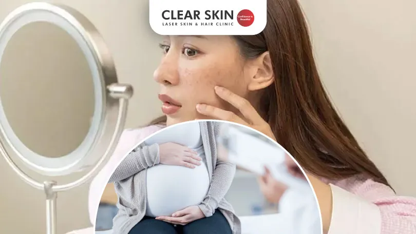 Melasma Treatment During Pregnancy