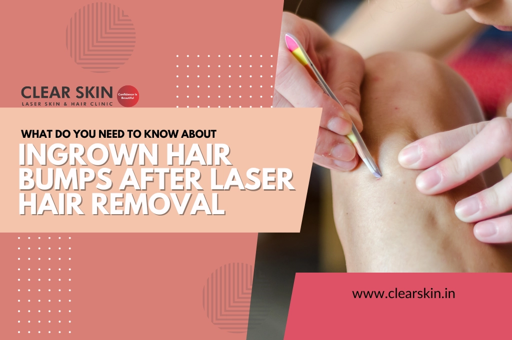 Laser Hair Removal: Benefits, Side Effects And What To Expect