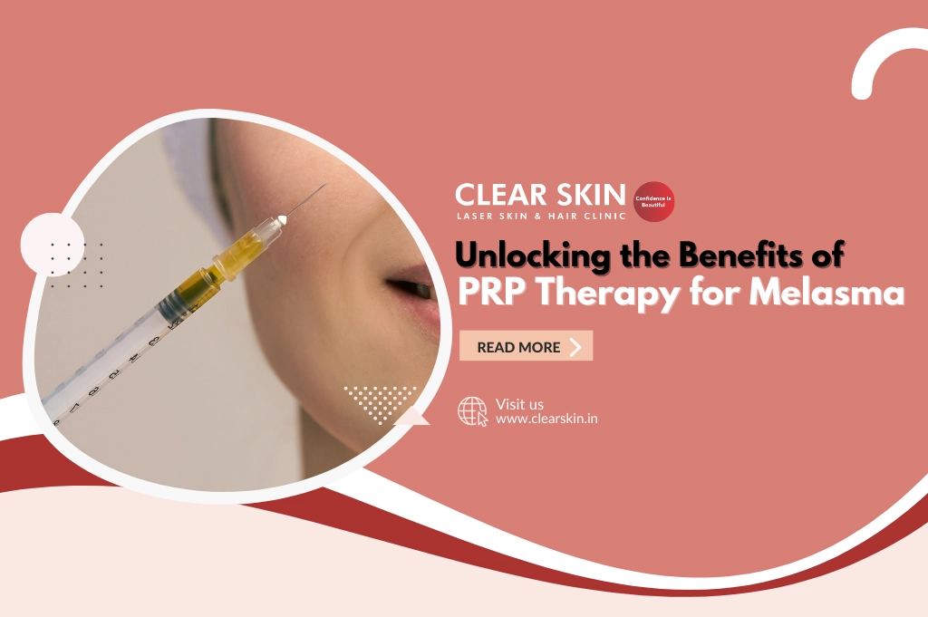 Unlocking the Benefits of PRP Therapy for Melasma