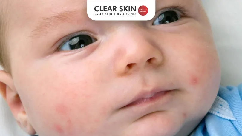 Acne in Babies - Causes, Symptoms and Treatment 