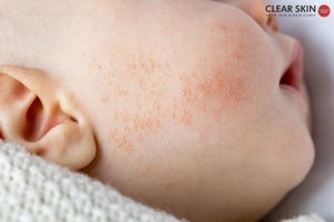 Conditions that May Resemble Baby Acne 