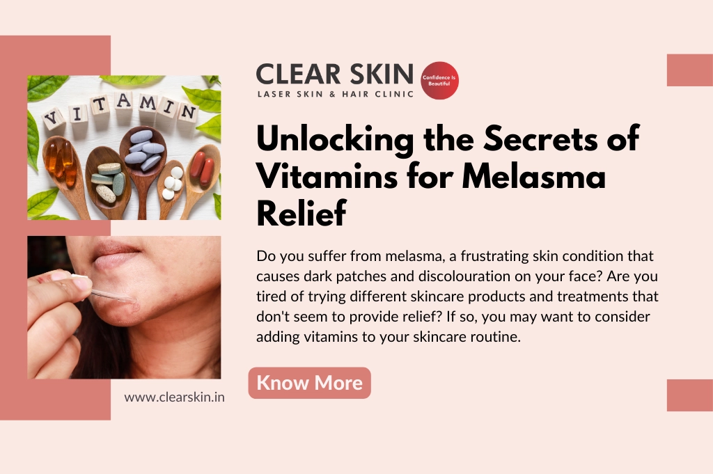 Unlocking the Secrets of Vitamins for Melasma Relief