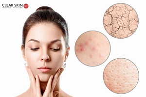 Why does acne occur in Dry Skin Types?