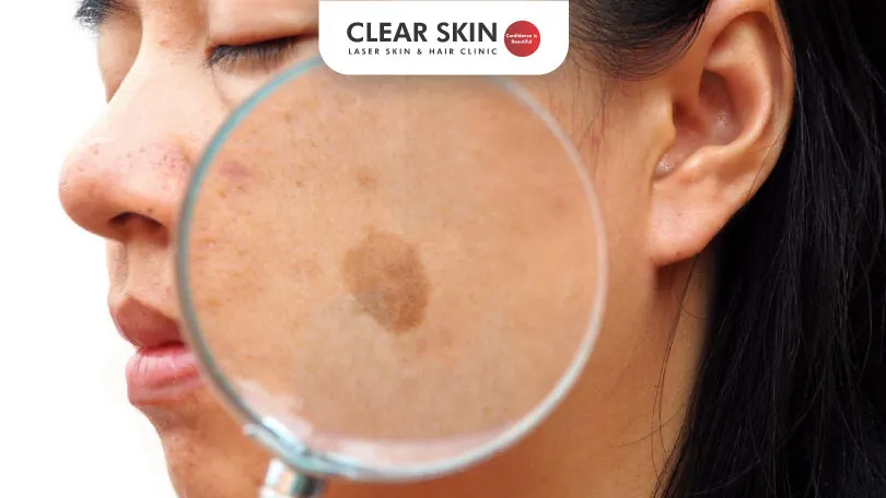 Is Melasma Cancerous clear skin pune