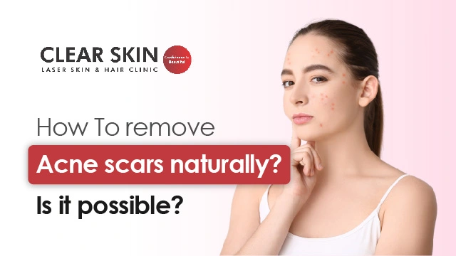 Remove Acne Scars Naturally