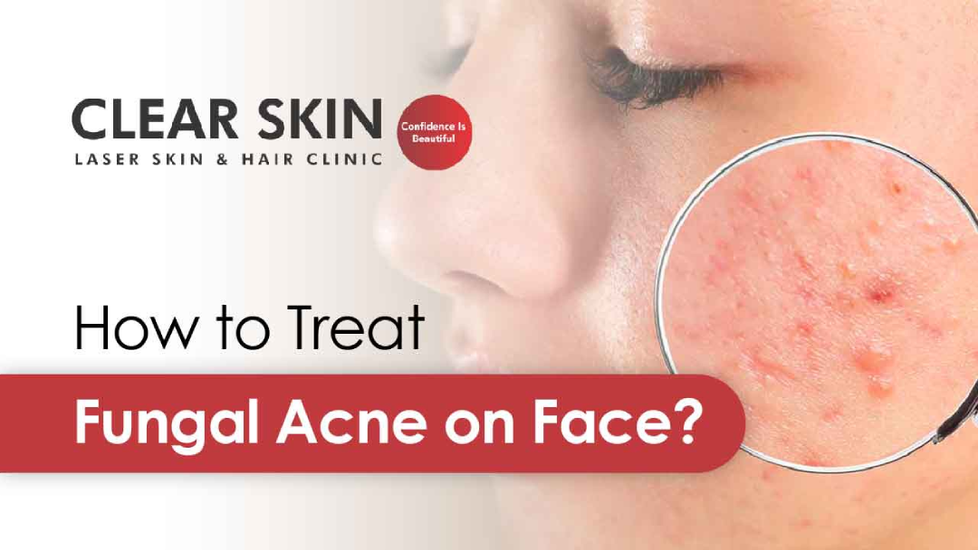 Fungal Acne: What Is It And How To Treat It