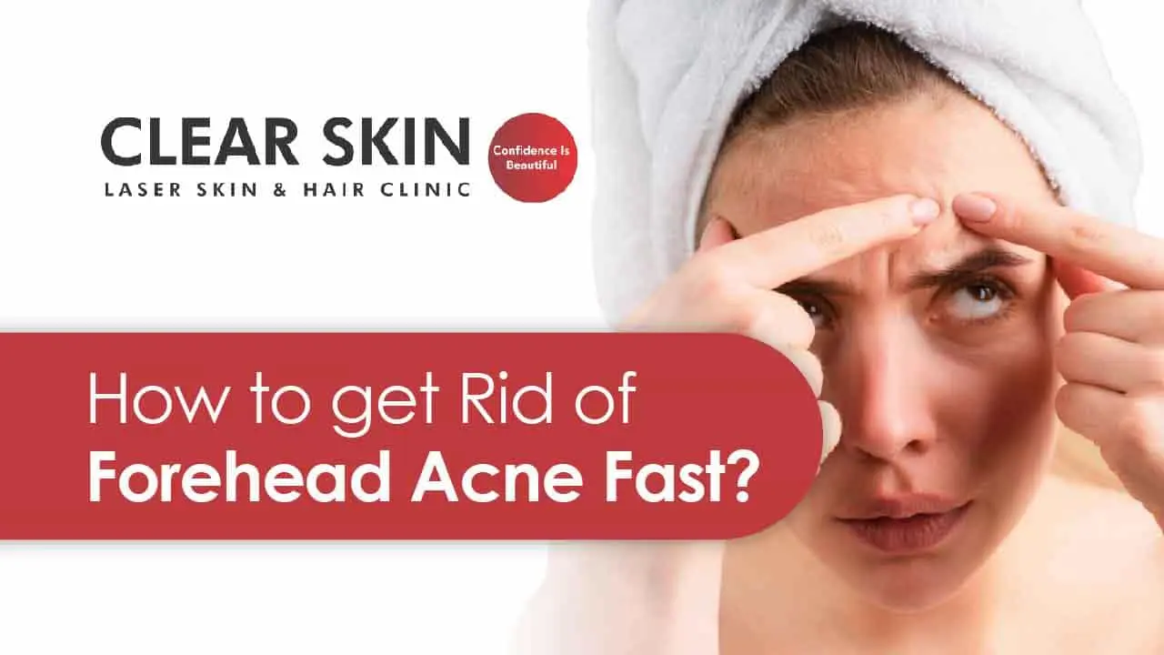 Forehead Acne Removal