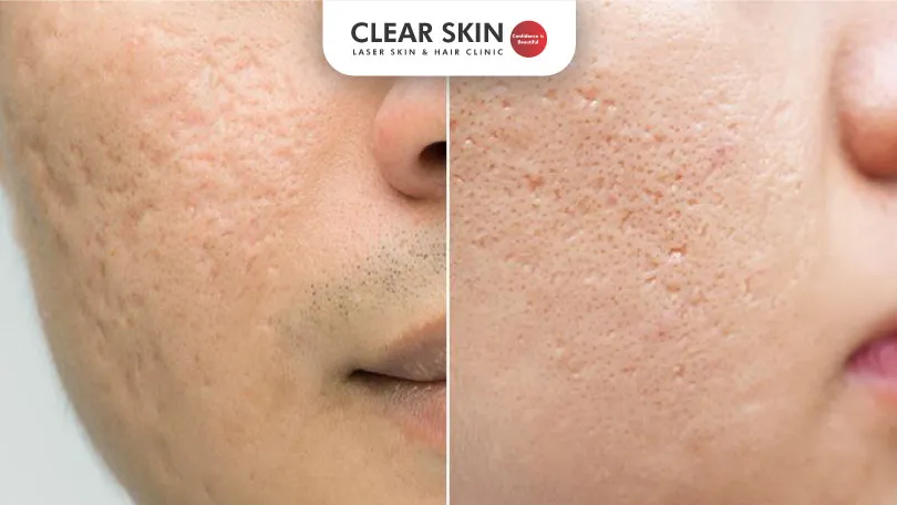 Ultimate-Guide-How-to-Remove-Acne-Scars-Effectively-clear-skin-pune Ultimate Guide How to Remove Acne Scars Effectively clear skin pune