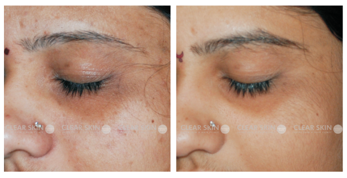 under eye dark circles before and after result