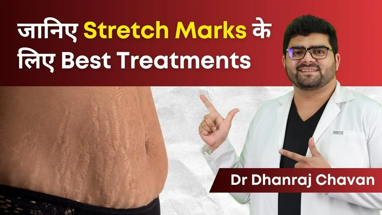 Stretch marks Treatment and Causes Clear Skin
