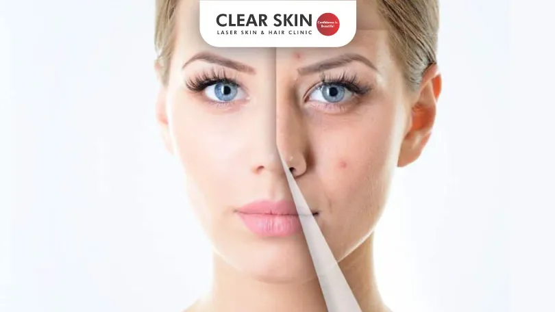 5 Myths About Acne Scars Clear Skin Pune