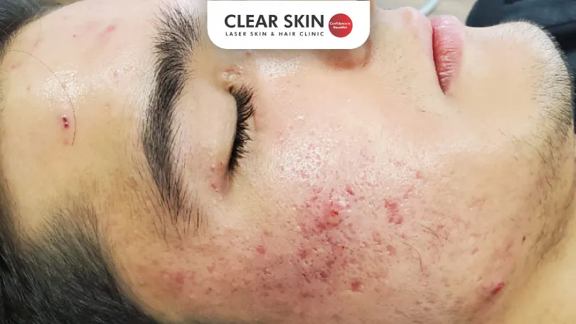 Acne-Pits-Various-Treatment-Modalities-That-Heal-Your-Skin-Clear-Skin-Pune Acne Pits Various Treatment Modalities That Heal Your Skin Clear Skin Pune