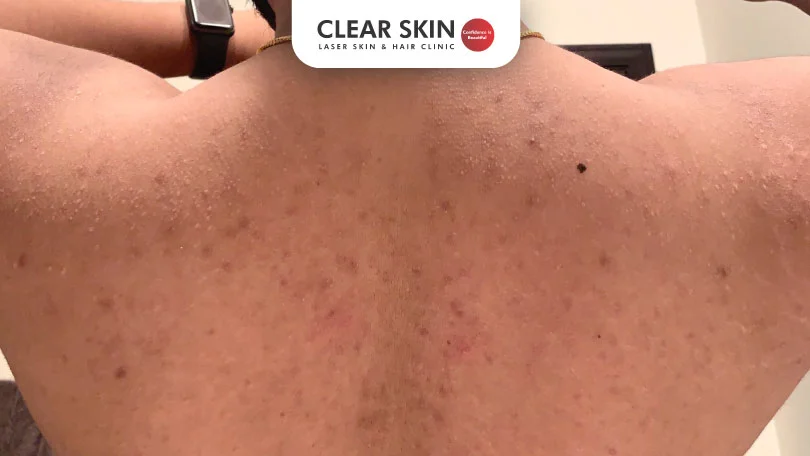 Best Treatments For Back Acne And Body Scars Clear Skin Pune