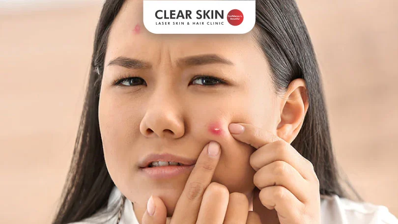 Blind-Pimple-Causes-Clear-Skin-Pune Blind Pimple Causes Clear Skin Pune